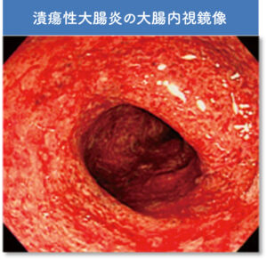潰瘍性大腸炎の大腸内視鏡像