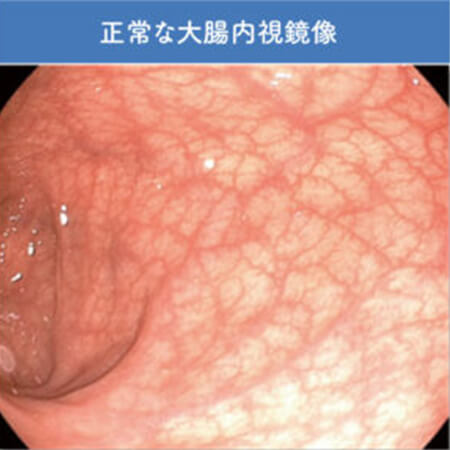 正常な大腸内視鏡像