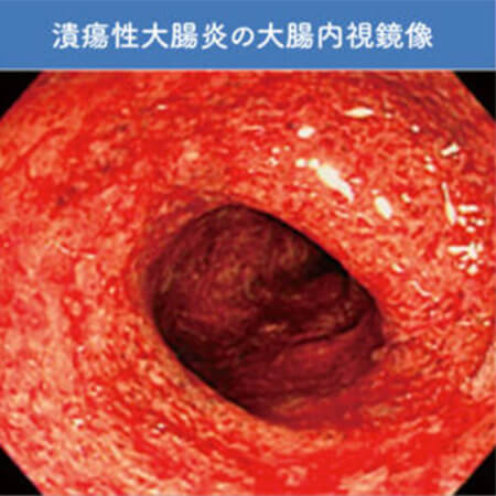 潰瘍性大腸炎の大腸内視鏡像